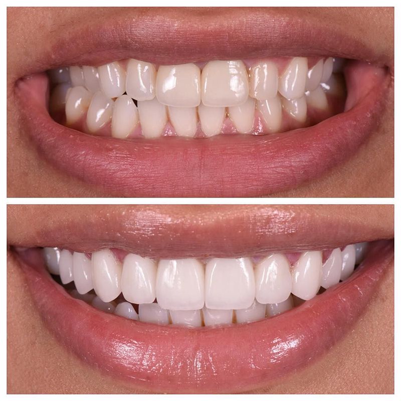 Facette Dentali - Prima e dopo