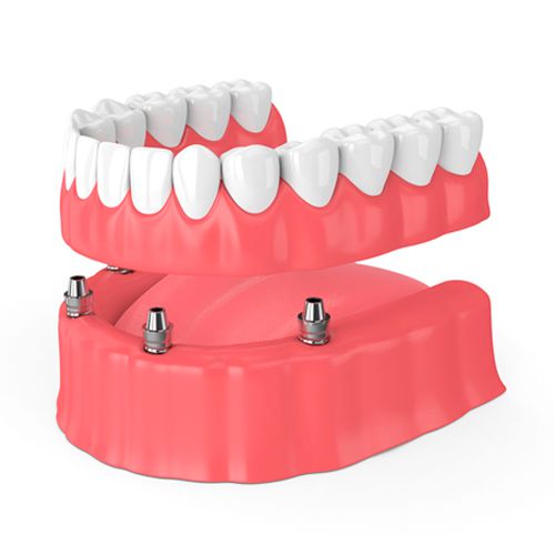 Implantologia Dentale - All On Four