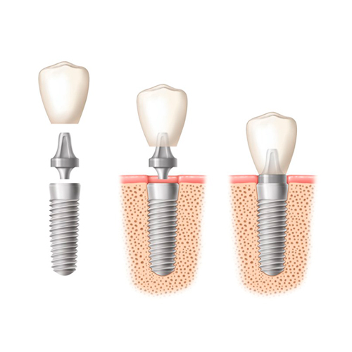 Implantologia Dentale